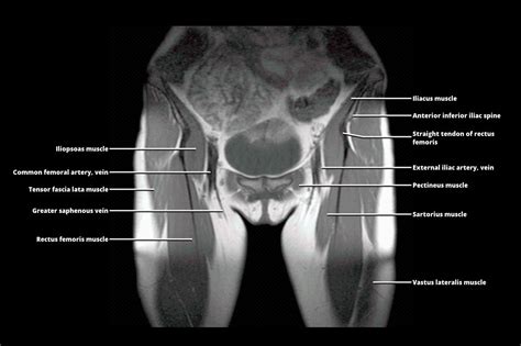 Does a Hip MRI Show the Groin? Exploring the Intersection of Imaging and Anatomy