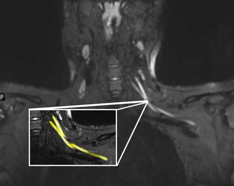 Does an MRI Show Nerve Damage: Exploring the Intricacies of Medical Imaging and Neural Pathways